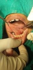 Cystic swelling at floor of mouth, removed successfully.